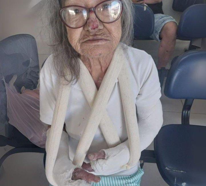  Idosa quebra os dois braços ao escorregar no lixo caído na calçada